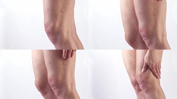 银屑病关节炎，女性膝盖上有皮肤牛皮癣。左膝关节牛皮癣患者的滑液。炎症性关节炎引起肿胀、发红、疼痛和关