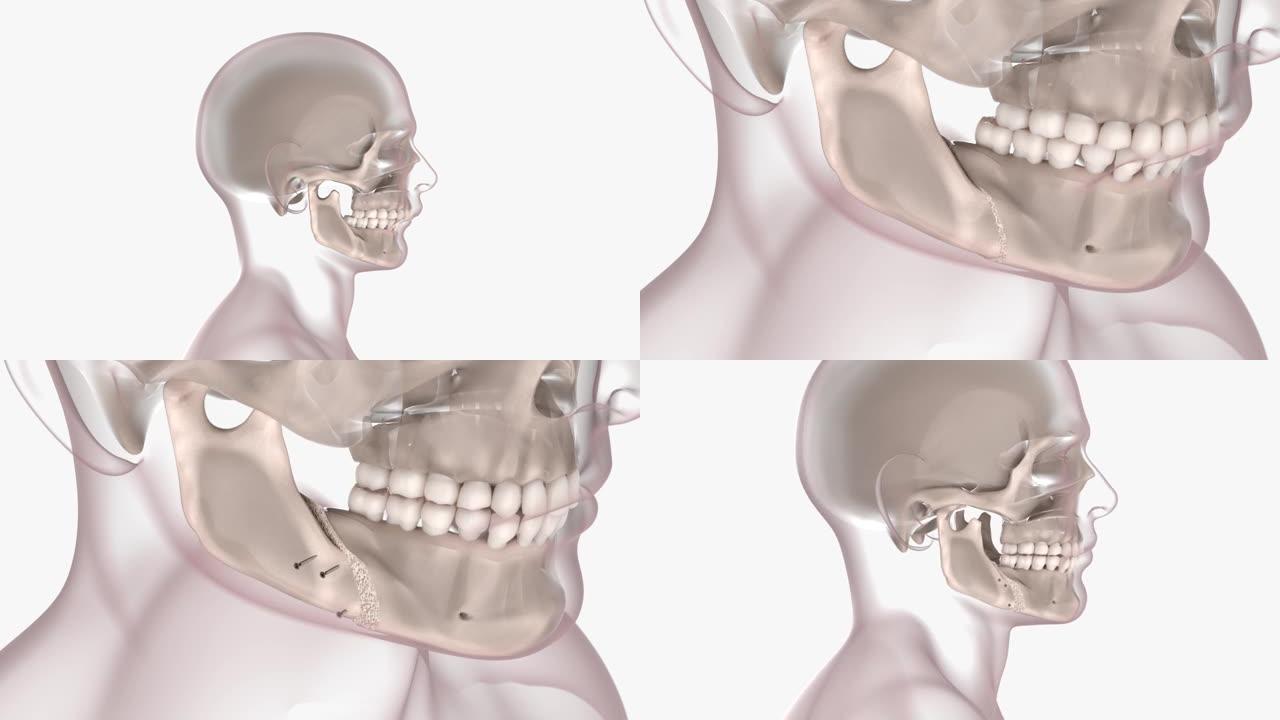 正颌手术三维3D动画模型智慧医疗
