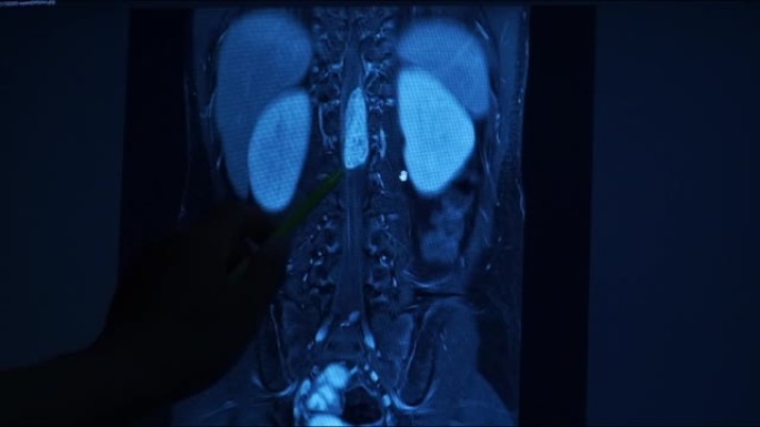 MRI腰椎首先查看正常脊柱，2查看发现脊髓左侧至远端硬膜外髓质肿块。