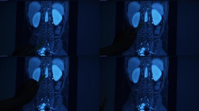 MRI腰椎首先查看正常脊柱，2查看发现脊髓左侧至远端硬膜外髓质肿块。
