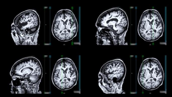 大脑的核磁共振成像。