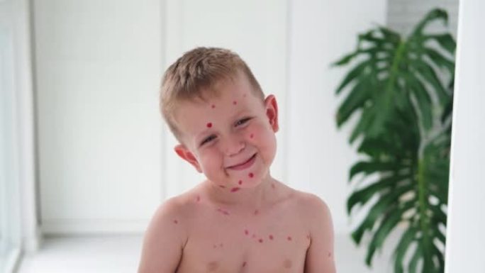 画的是一个快乐的男孩，脸上起了水痘疹子。在孩子的皮肤上用红色治愈霜治疗水痘。