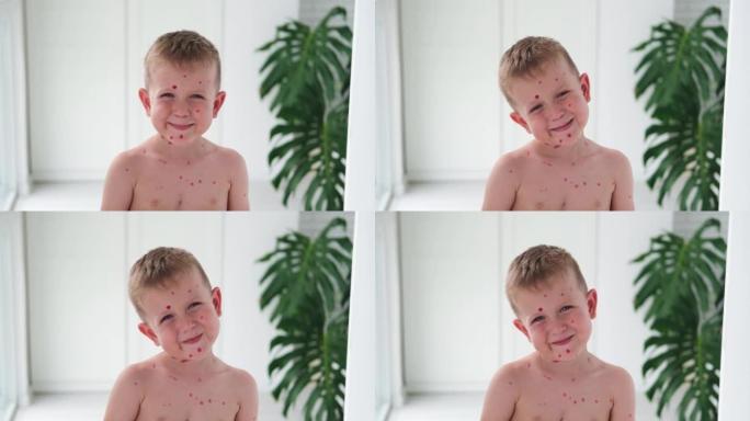 画的是一个快乐的男孩，脸上起了水痘疹子。在孩子的皮肤上用红色治愈霜治疗水痘。