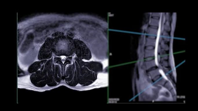 MRI l-s脊柱。