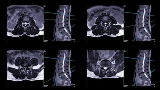 MRI l-s脊柱。