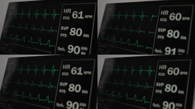 循环: 患者监护仪显示生命体征心电图心电图EKG，血氧饱和度SPO2和呼吸。体检。4k视频录像动画。