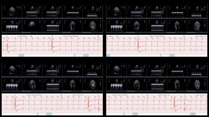 这是echo心脏经胸心动图超声屏幕的屏幕截图，该屏幕正在数字平板电脑上检查心脏