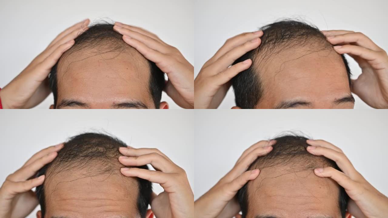 不愿透露姓名的亚洲男子担心自己的脱发和秃头问题。
