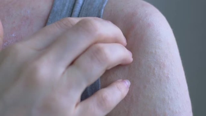 特写显示了女人的右肩和胸部上方的区域。皮肤上不同大小的红点。用指尖抓斑点。病毒性疾病
