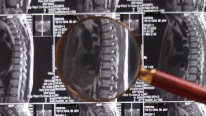 MRI腰椎背景，磁共振断层扫描。医生检查腰椎MRI，并夹住脊柱和神经椎间盘。