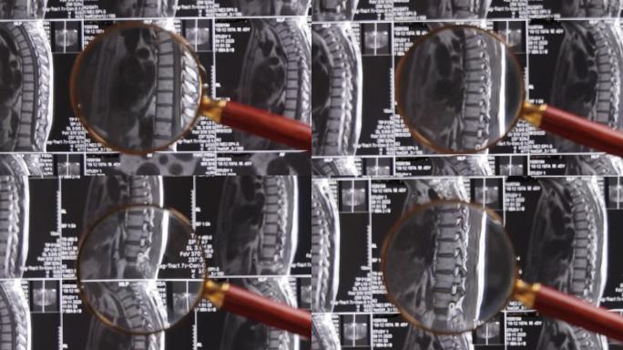 MRI腰椎背景，磁共振断层扫描。医生检查腰椎MRI，并夹住脊柱和神经椎间盘。