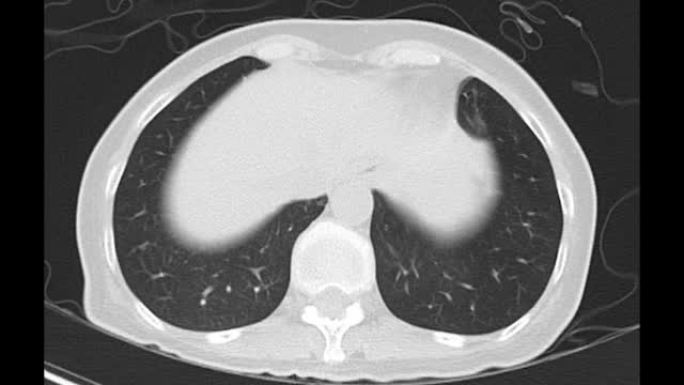 胸部或肺部CT扫描以诊断肺部疾病。