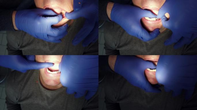 牙医正在为患者制作牙科植入物假体