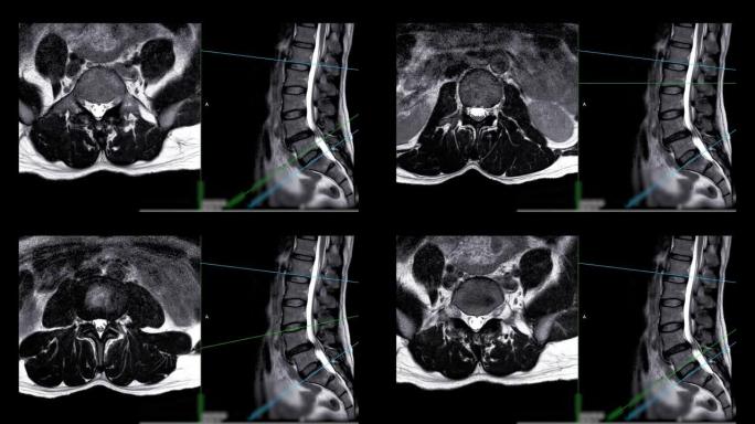 MRI l-s脊柱。