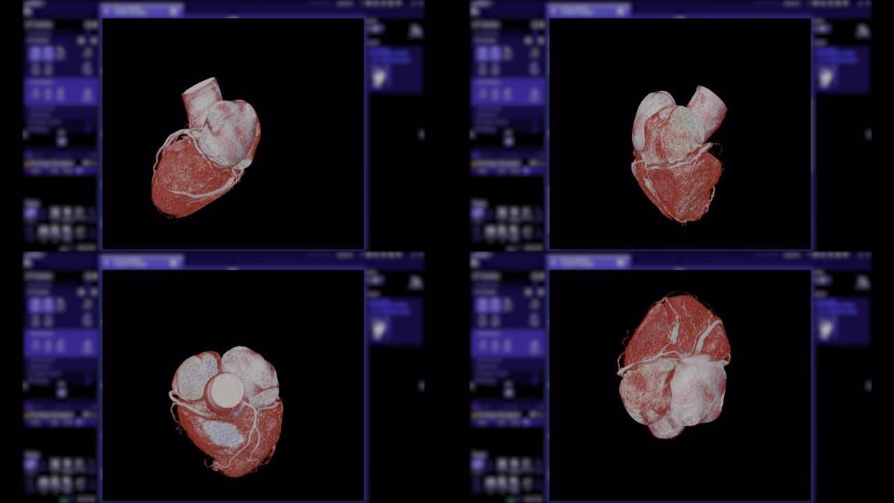 CTA冠状动脉三维渲染。