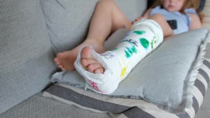 年轻的高加索女孩躺在沙发上抓挠受伤的断骨腿上的瘙痒皮肤，用整形石膏石膏壳稳定下来