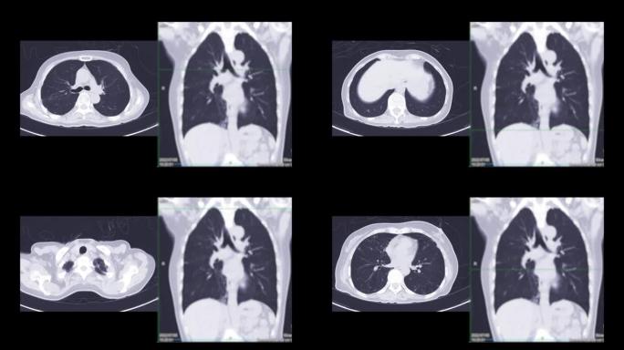 胸部或肺部CT扫描以诊断肺部疾病。