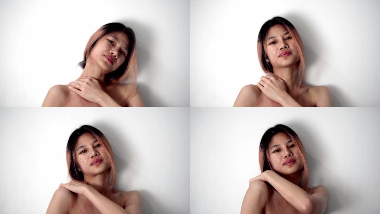 皮肤过敏的亚洲女性正在抓挠自己的身体和面部。