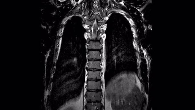 MRI脊柱和肺部扫描，背部和骨骼特写的磁共振成像，延时