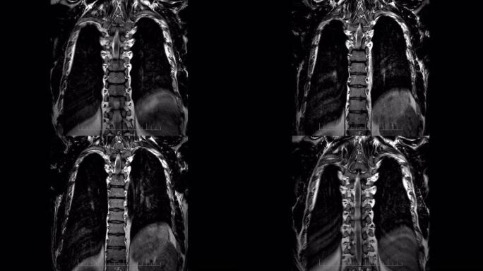 MRI脊柱和肺部扫描，背部和骨骼特写的磁共振成像，延时