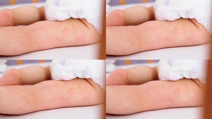 儿童腿上的过敏性皮肤，红色皮疹皮炎，特写特应性湿疹