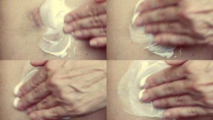 在擦伤的腿上涂抹药膏，特写。