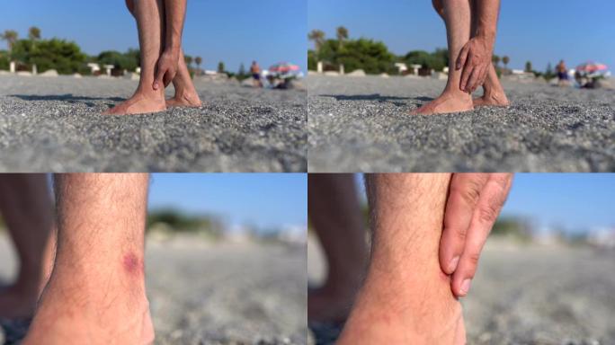 男性的手在海滩上抓腿，赤脚的人呆在卵石岸上，用水母受伤触摸他的腿。男性感到痒，在水中咬了一口鱼。夏天