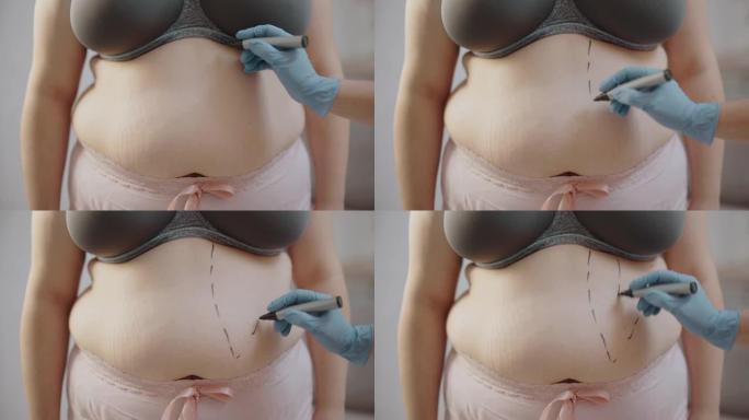 医生在肥胖的女性腹部做标记，整形手术，脂肪去除，美容