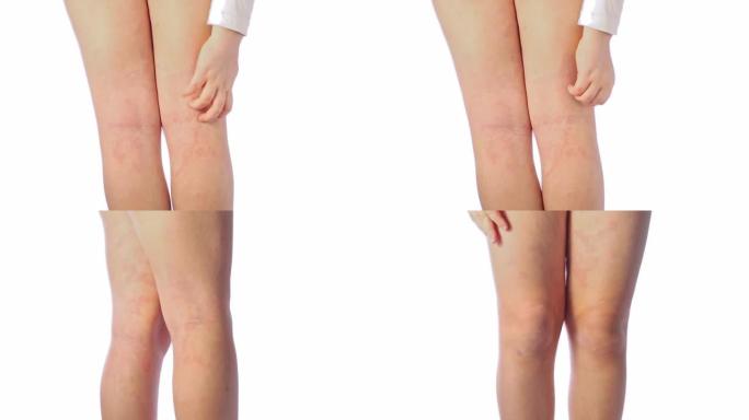 儿童膝盖后腿部的急性特应性皮炎是皮肤的皮肤病。腿部大，红色，发炎，鳞状皮疹。患有严重特应性湿疹的青少
