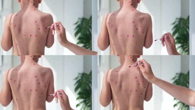 治疗溃疡从水痘，水痘用医用霜在孩子的皮肤。妈妈用红色药治疗孩子的背部。