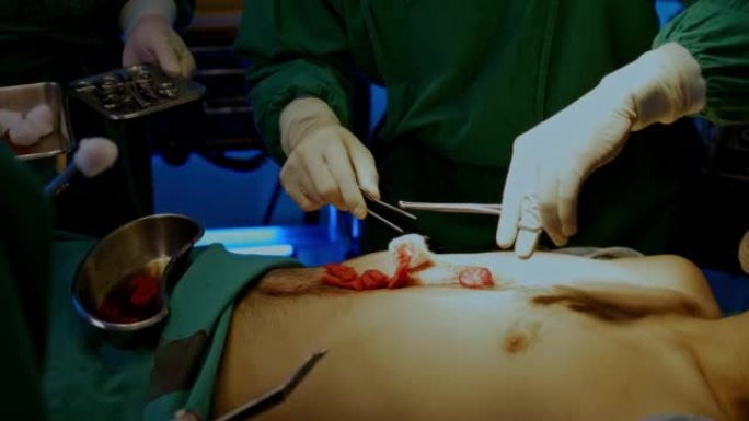 外科医生和小组医生助理正在急诊手术室为患者进行腹部手术。专家医疗团队采用现代治疗技术。医疗服务的概念