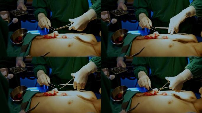 外科医生和小组医生助理正在急诊手术室为患者进行腹部手术。专家医疗团队采用现代治疗技术。医疗服务的概念