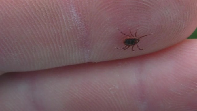 危险的寄生虫在人类皮肤上的硬蜱。