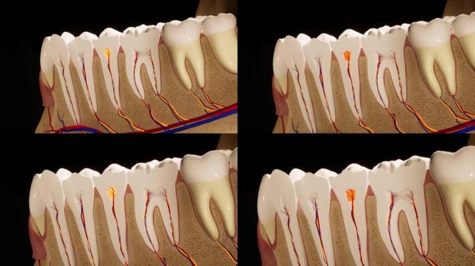 牙痛。牙齿的解剖详细部分。神经发炎。3D动画