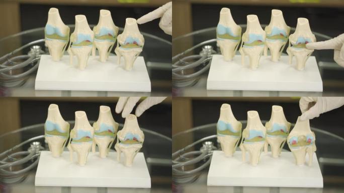 膝关节结构，骨关节炎，特写，医学背景，教程，教学，教育，视频，慢动作的模型。