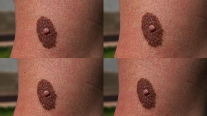 人皮肤表面异常痣的宏观注射，皮肤科医生检查