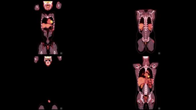 正电子发射断层扫描 (PET) 扫描