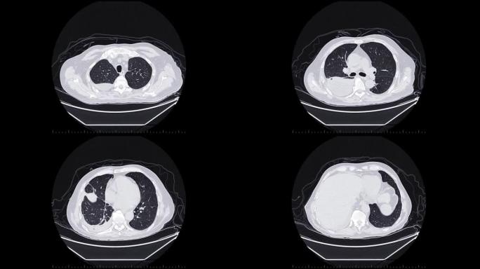 胸部CT或肺部CT扫描。