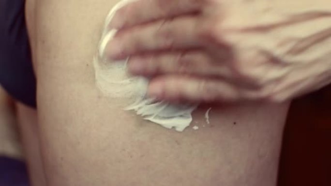 女人的手在腿上的一块大瘀伤上涂抹乳膏。特写。