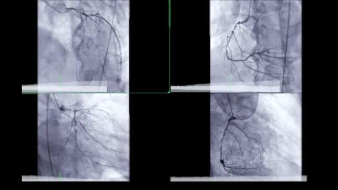 冠状动脉血管造影。