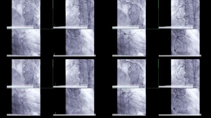 冠状动脉血管造影。
