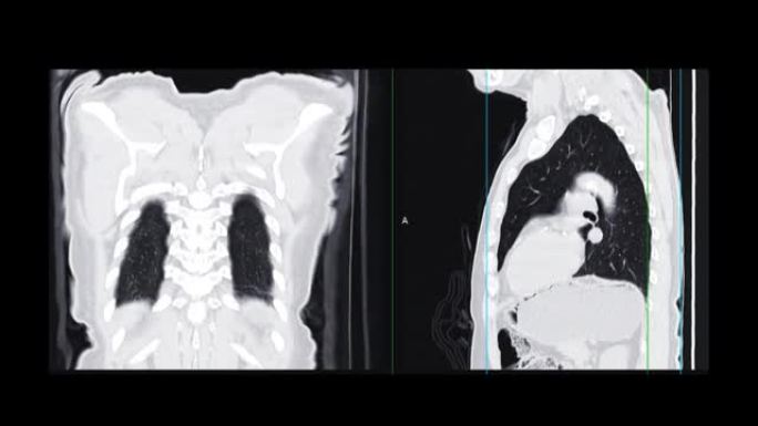 胸部CT或肺部CT扫描。