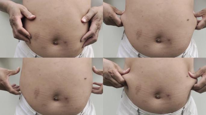 脂肪脂肪围绕腰部，胖乎乎的脂肪在男性的腹部。