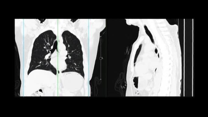 胸部CT或肺部CT扫描。