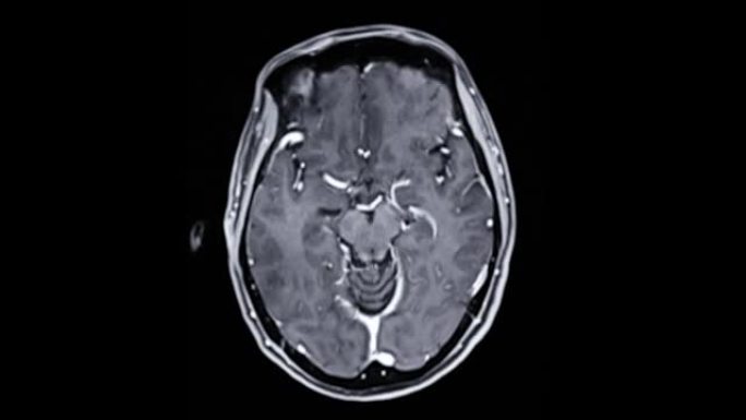 用钆造影剂对大脑进行MRI。