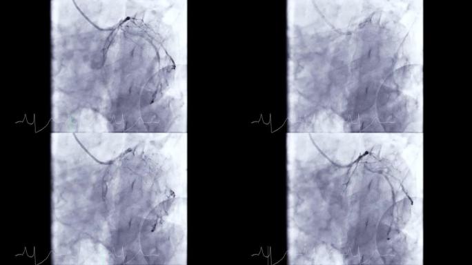 冠状动脉血管造影。