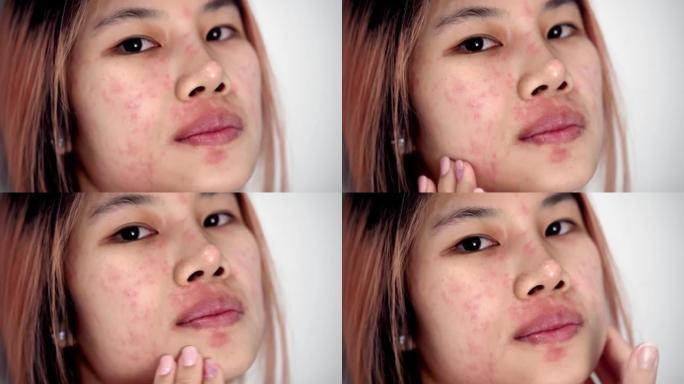 亚洲妇女因皮肤过敏感染疾病而抓伤脸。她脸上有红色皮疹。