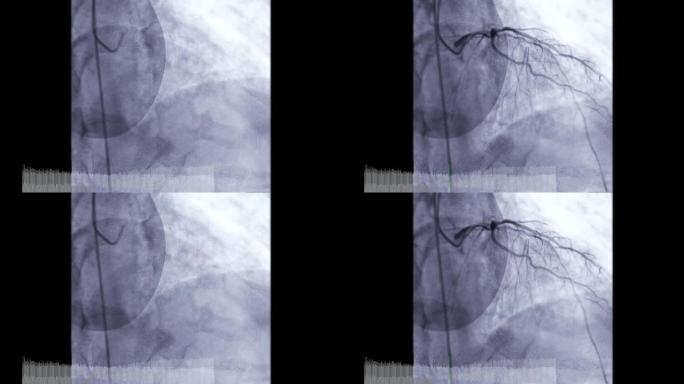 冠状动脉血管造影。