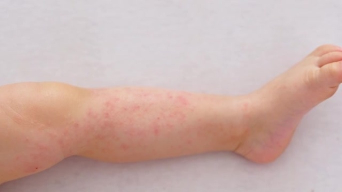 异位性湿疹皮炎对睡觉的婴儿腿，红色刺激过敏性疾病