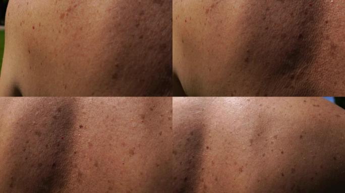 摄像机沿着患者背部皮肤移动，皮肤上覆盖着良性或恶性痣